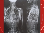 Menina de 12 anos tem cirurgia de escoliose paga pelo Governo de Rondonia